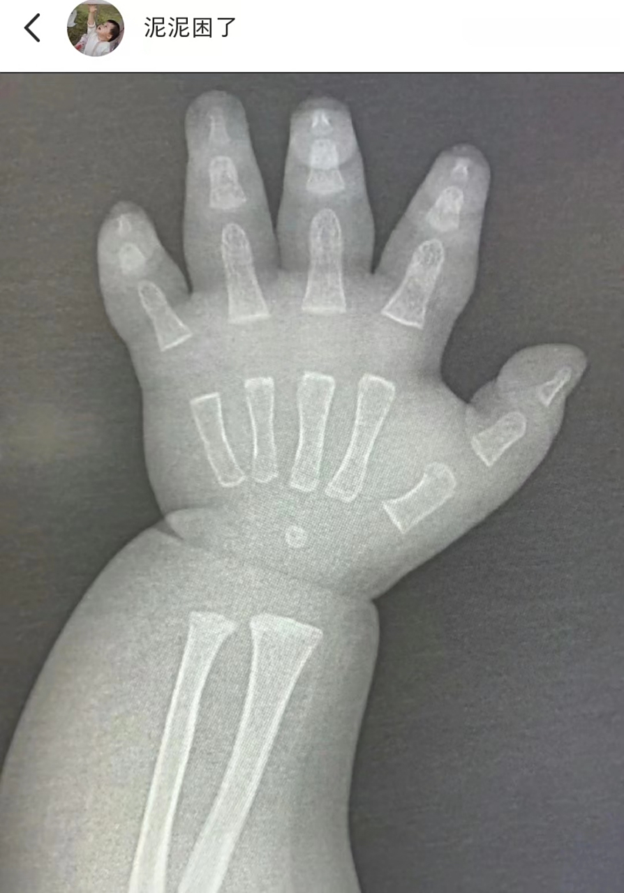 x光下的婴儿手手好可爱啊,哈哈哈哈哈,肉肉得,骨缝没有连接
