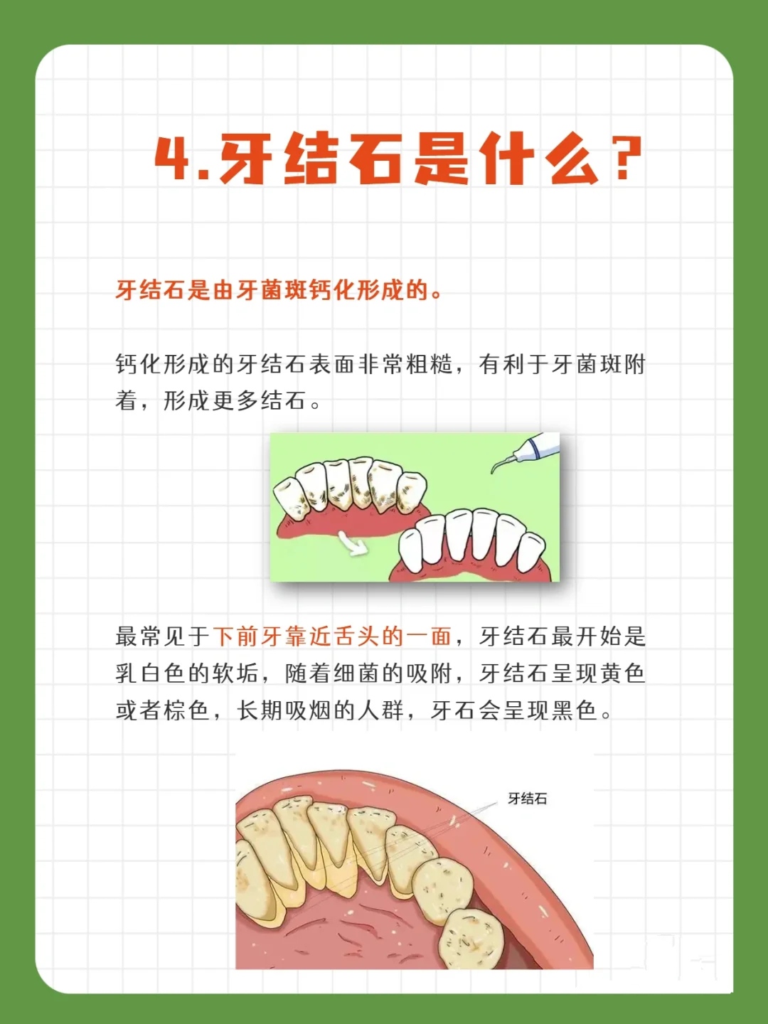 牙菌斑vs牙结石
