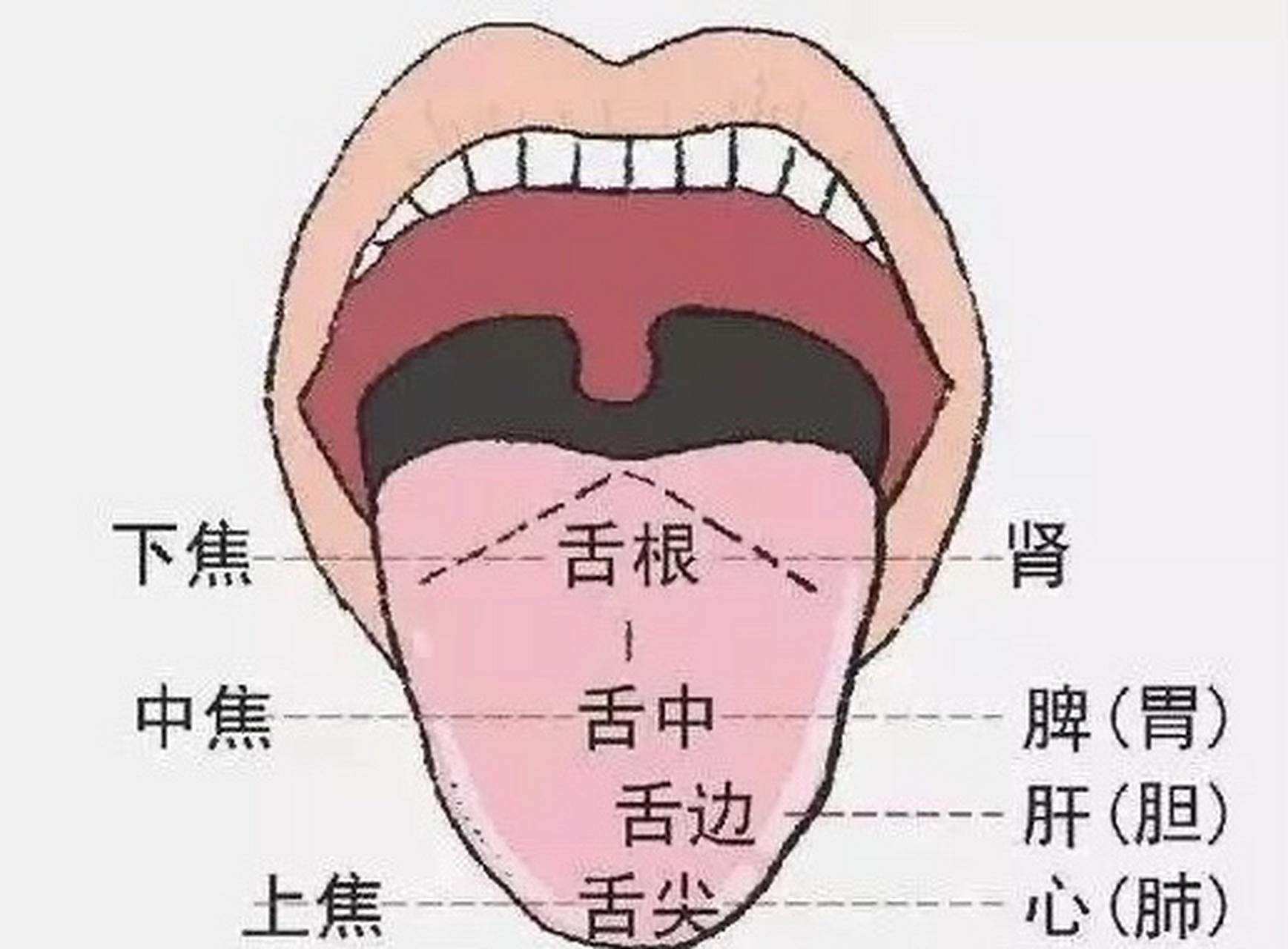 看舌知健康之舌刺 芒刺舌……(舌乳头高起如刺,舌中芒刺)……胃肠火旺