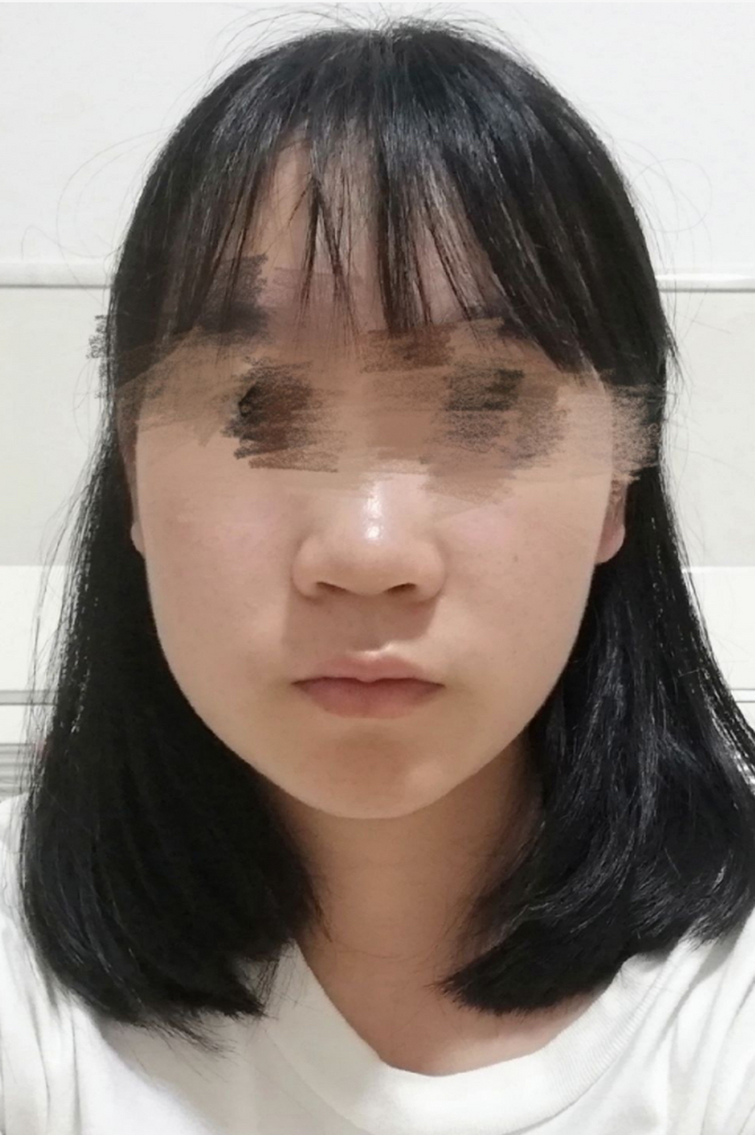 左右脸不对称,到底是什么原因呢?