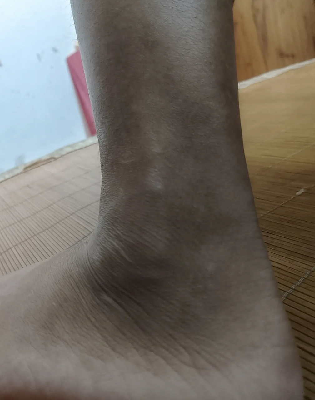 谁能救救我,透析8个月两条腿和手都黑成碳,一开始都怀疑是我洗不干净