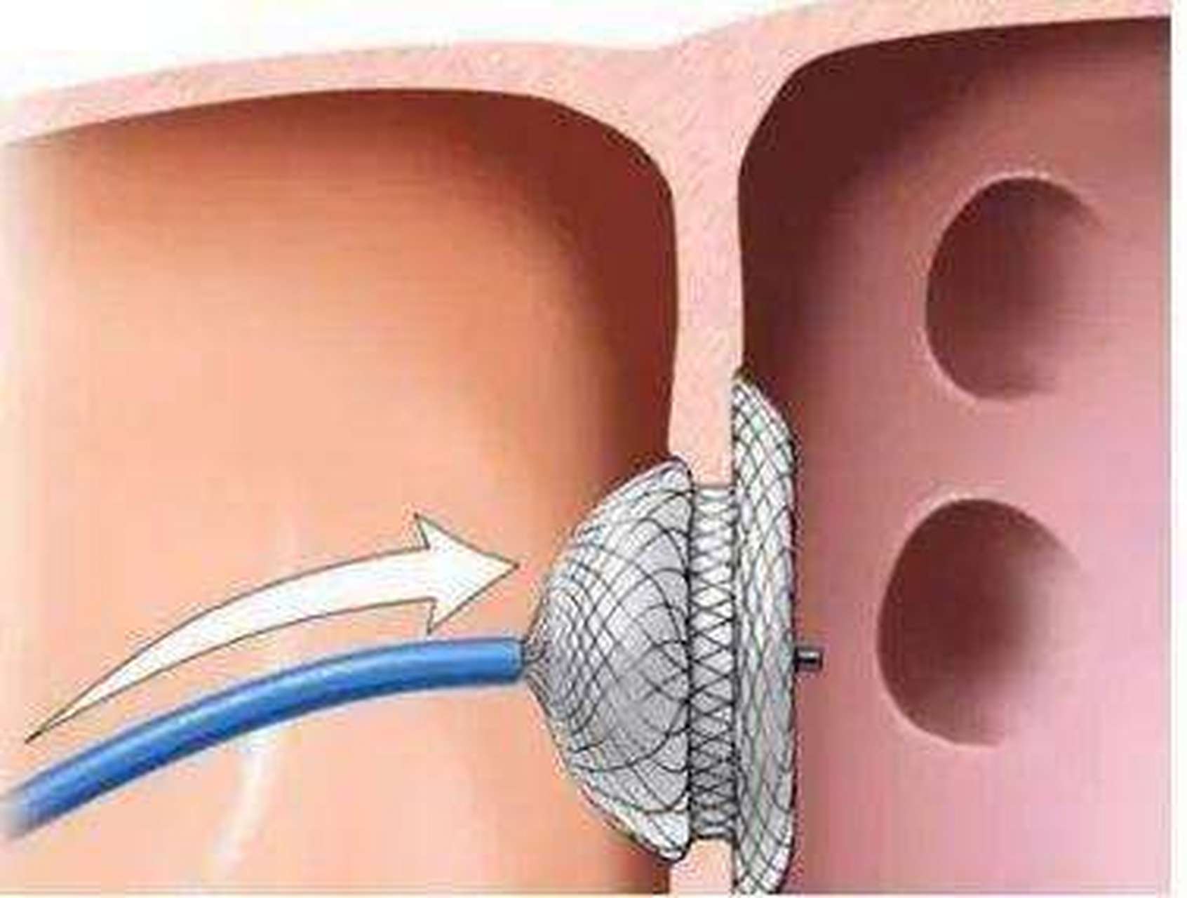 【卵圆孔未闭介入封堵器会脱落吗?