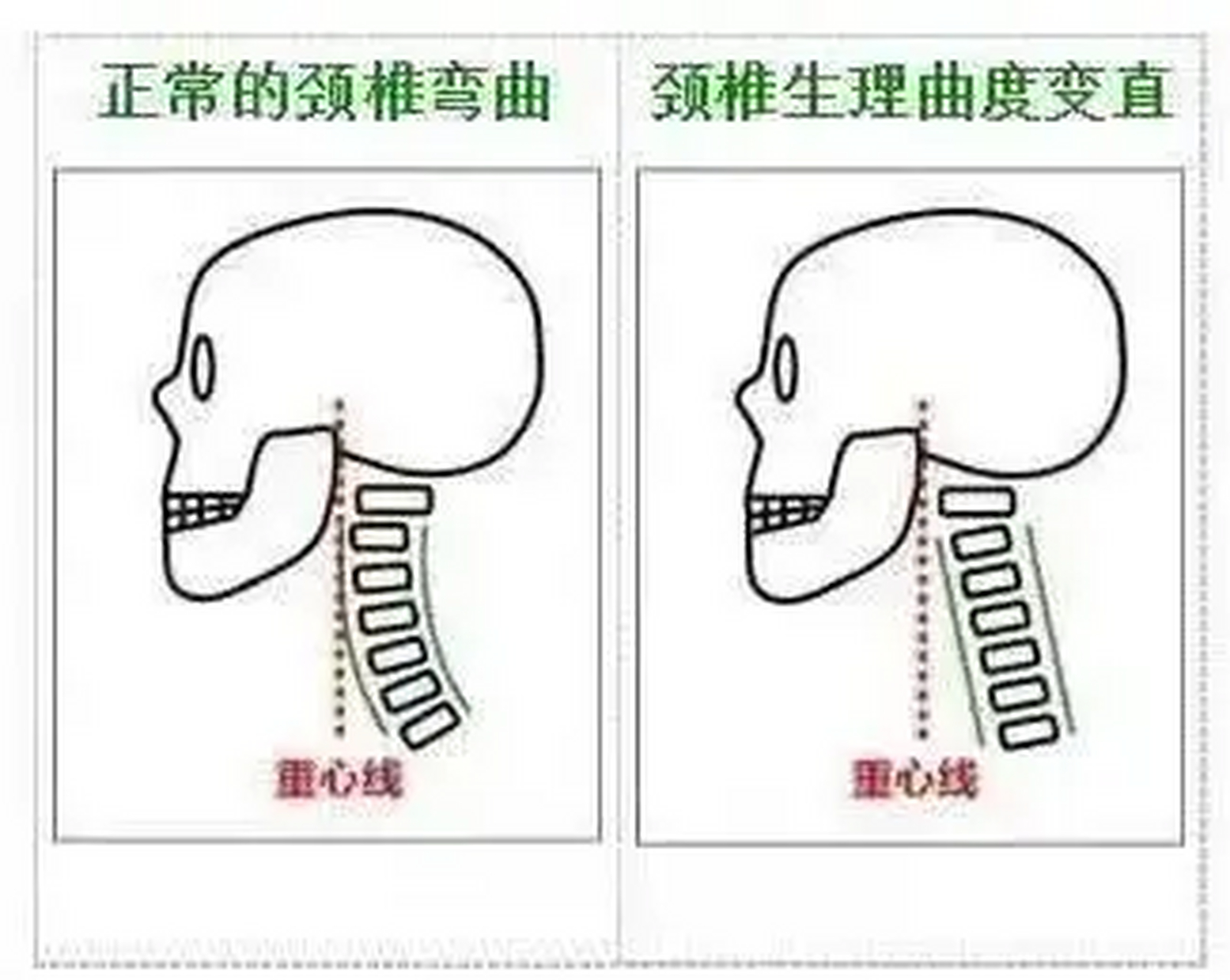 其实,从严格的定义上来讲,单纯"颈椎生理曲度变直"不是颈椎病