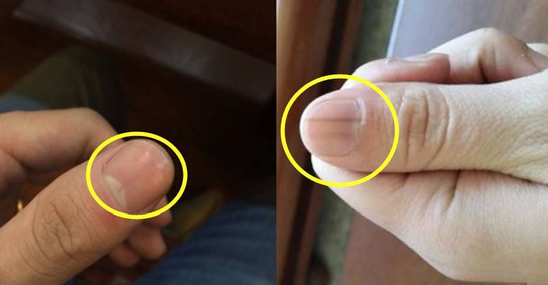 《指甲有竖纹是身体的什么信号》 指甲有横纹是身体的什么信号  第2张