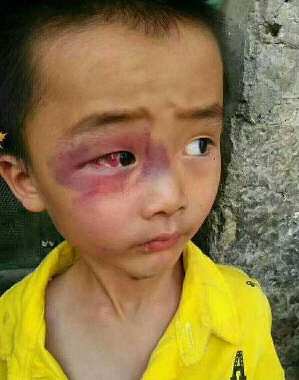 我们小区有个孩子把别的孩子眼睛弄伤了赔了十几万,可是眼伤的是一直