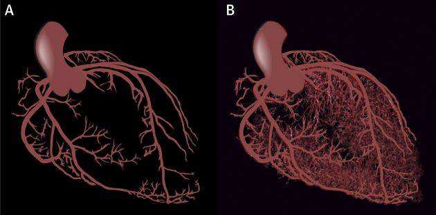 「一问一答」什么是冠状动脉微血管疾病?