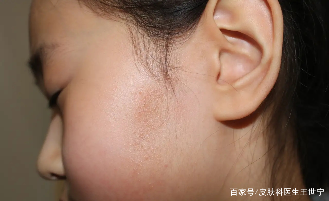 男生脸颊鸡皮肤还泛红(男生脸颊两侧暗红有鸡皮疙瘩)