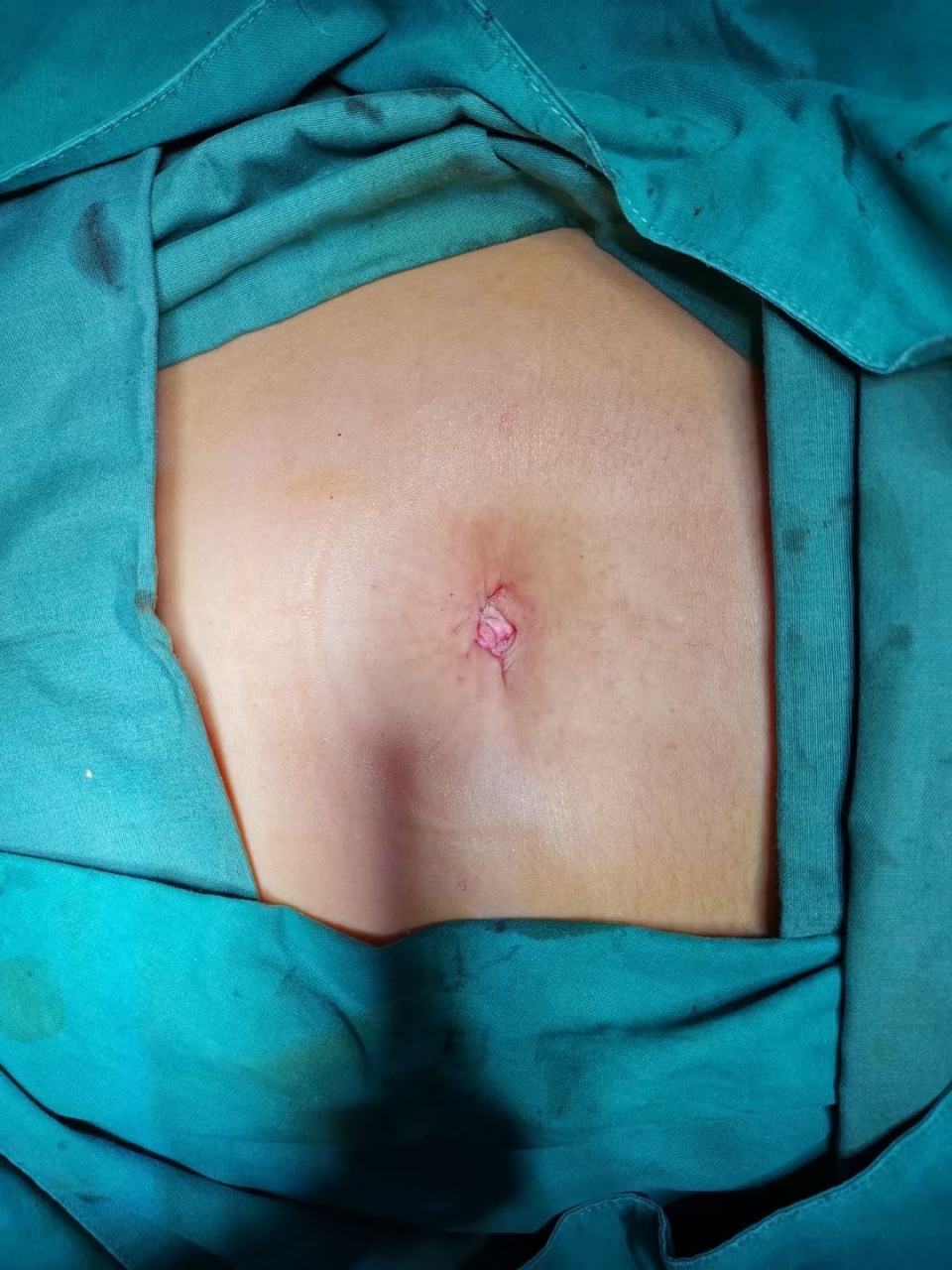 腹腔镜伤口恢复图 1月图片