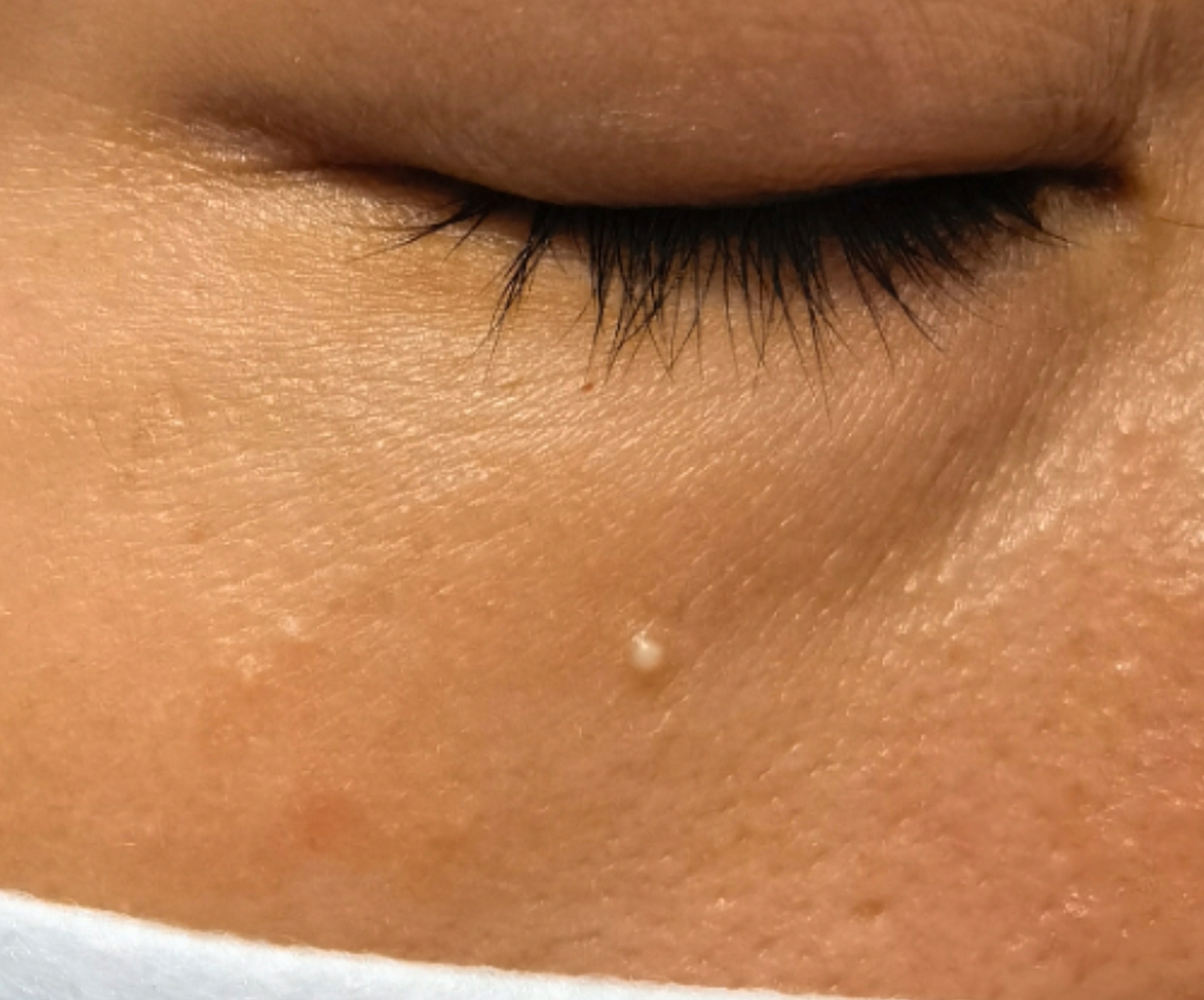 脸上的脂肪粒就是这颗白色的小丘疹,它的学名叫粟丘疹,可以认为是一个