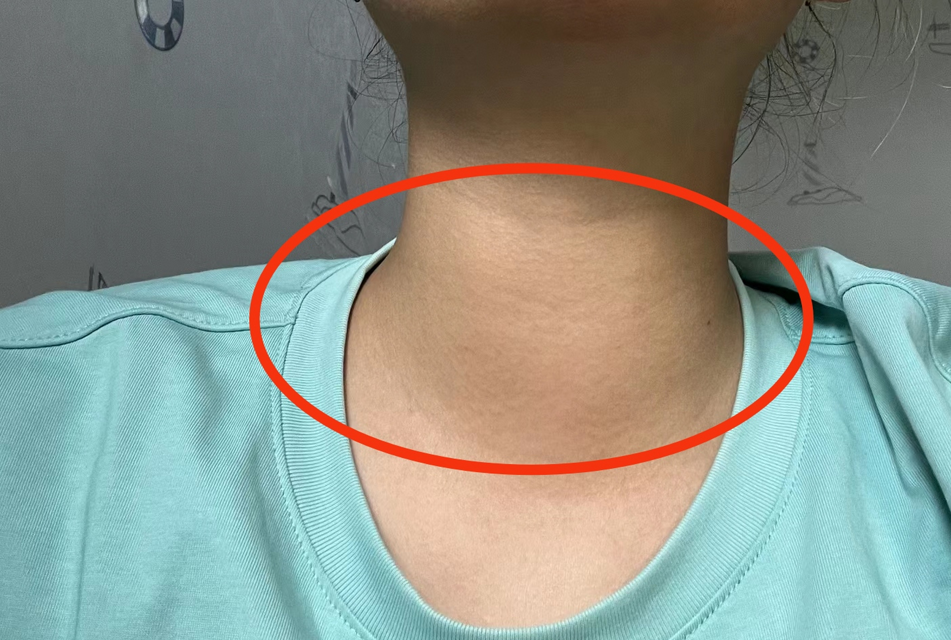 甲亢好了! 感恩坚持的自己