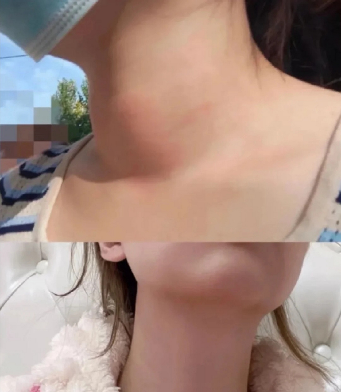 告别粗脖子,再见"甲亢"女孩.