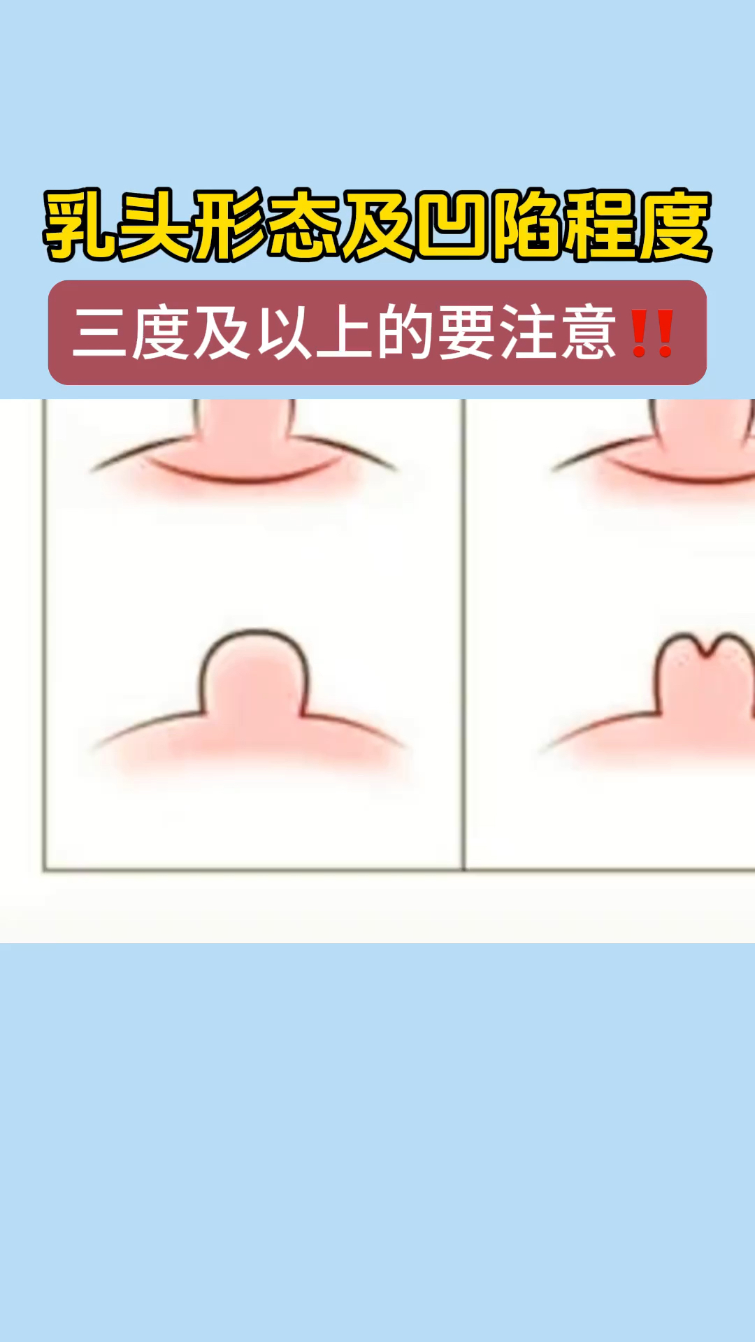 乳头凹陷程度演示,三度以上的要注意了!