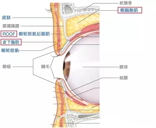 肿眼泡矫正,为什么要注意roof脂肪层?