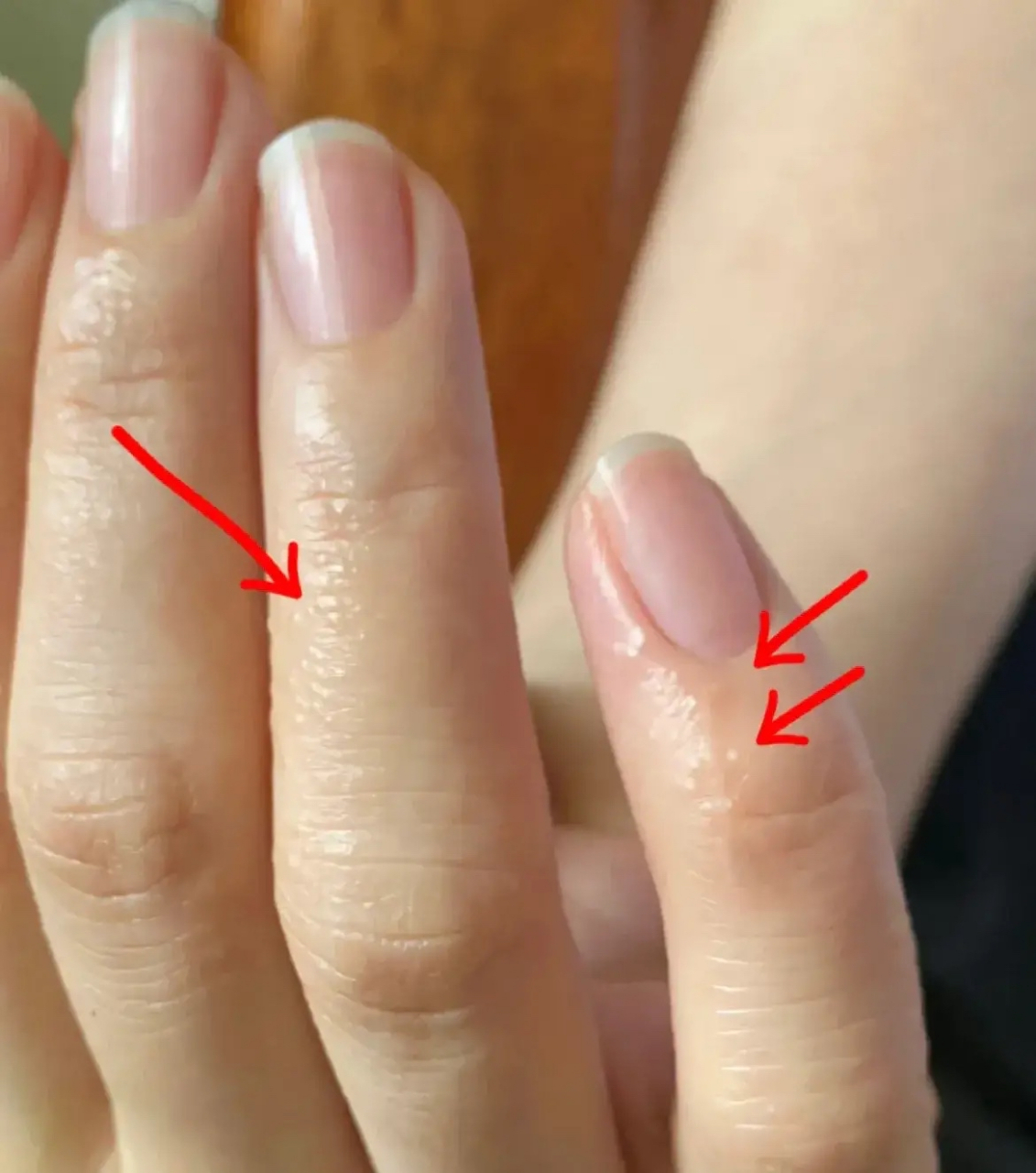 一到三伏, 手上就长痒痒的小水泡,还脱皮, 别担心,3个方法改善:  1,刚