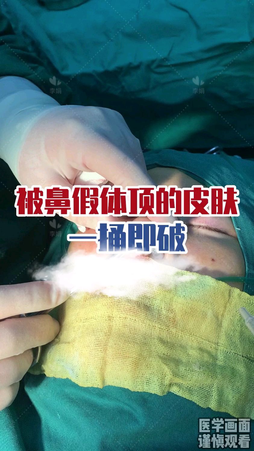 鼻假体 一旦出现下滑,建议及时取出或修复,以免穿破皮肤!