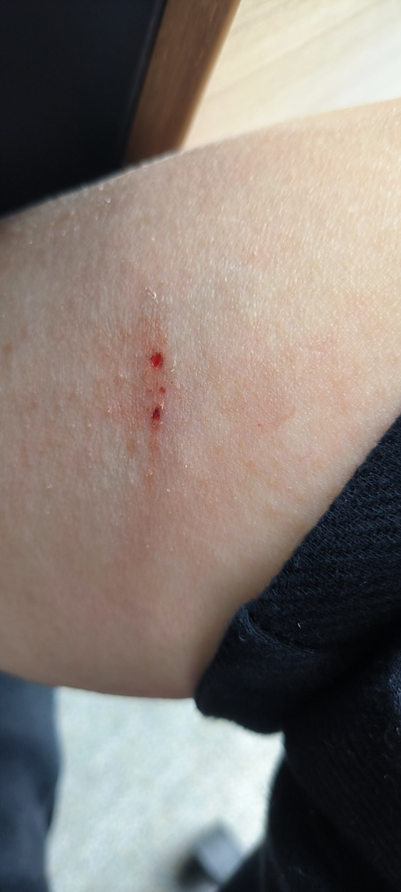 这是哪种蛇咬的牙印?没有发黑,应该是无毒吧.