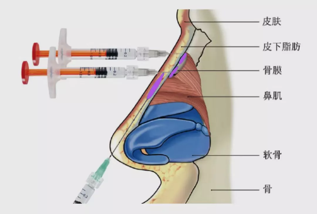 鼻基底玻尿酸注射手法图片