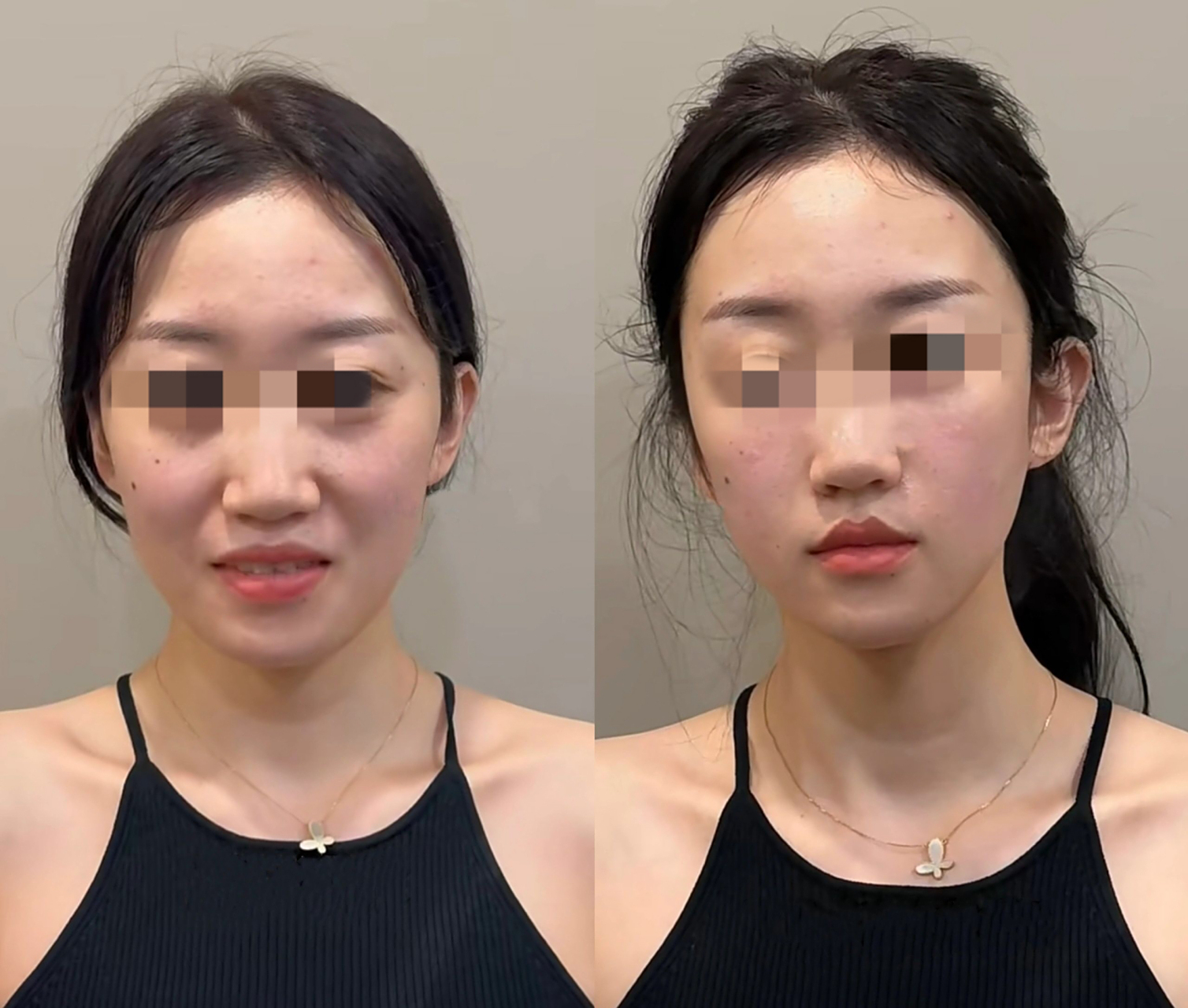 苹果肌复位即刻效果,即刻减龄  苹果肌熬夜下垂移位,法令纹显现,人也