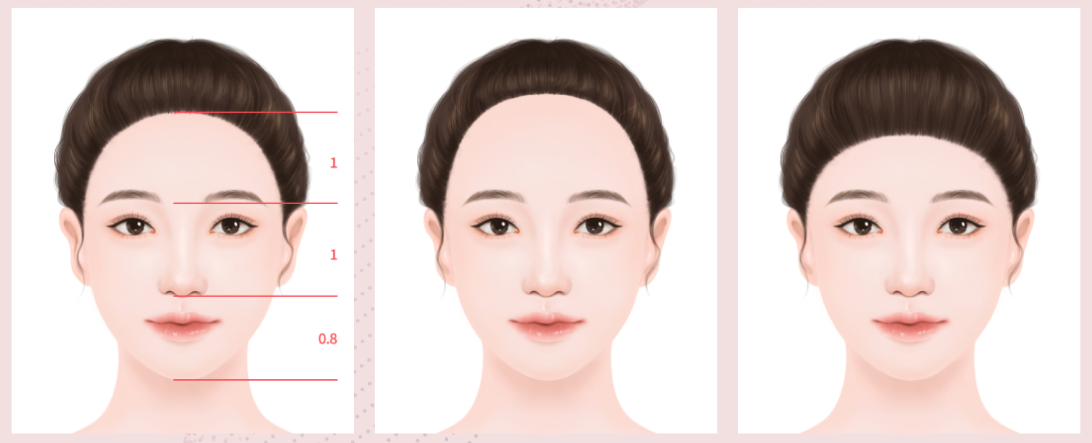 韩国女性植发,发际线毛发移植的主要特点在于审美设计