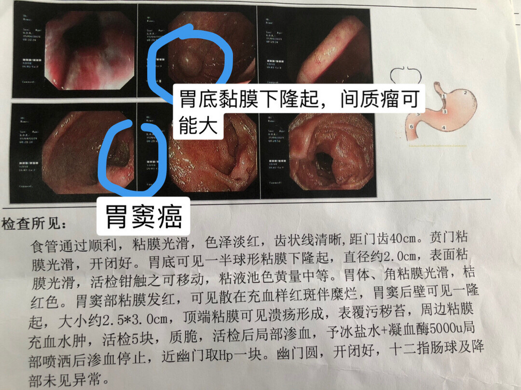 胃间质瘤合并胃窦癌 这两个疾病没有直接关系.