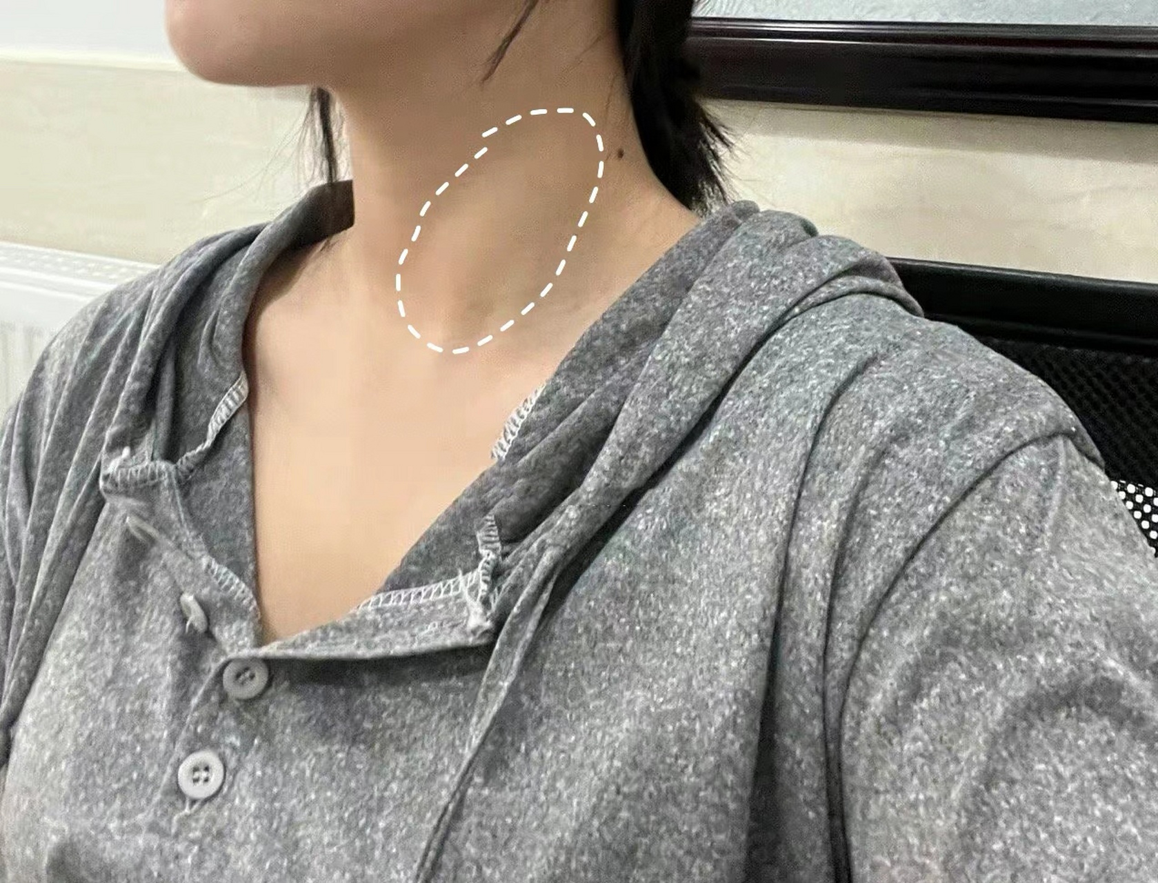 这么好看的脖子,你绝对没想到我有过甲状腺结节吧.