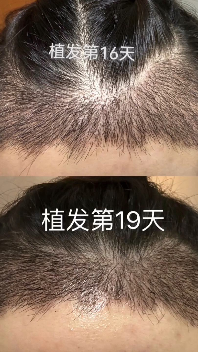 植发能不能再长出来(植发到底能不能长出来)