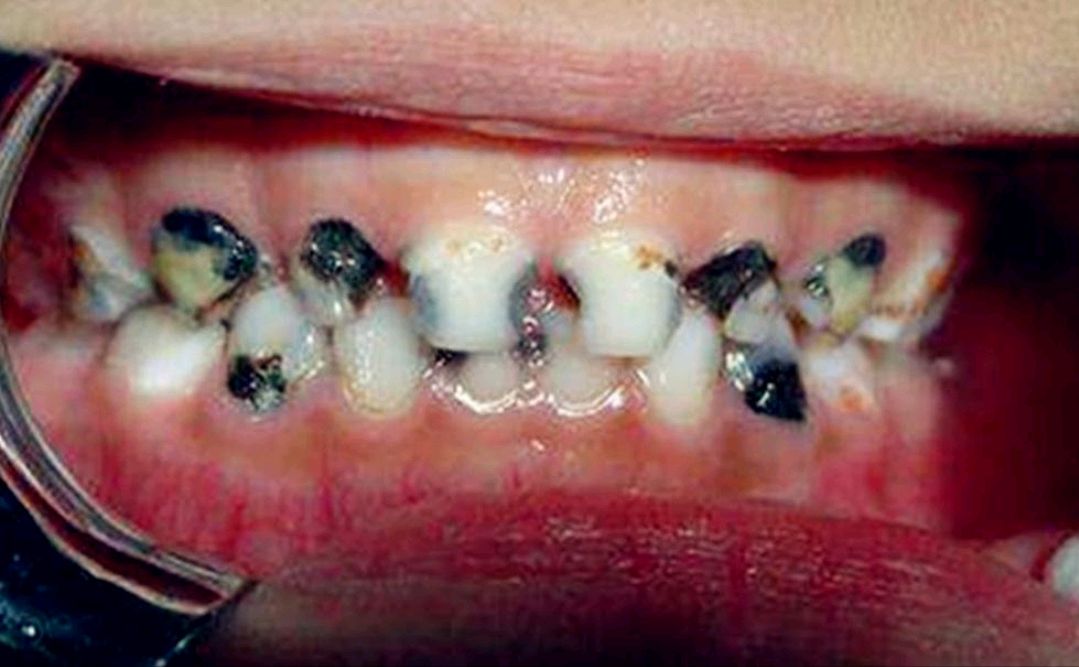 4岁孩子满口黑牙烂牙,花费15000,后悔没有早看到这篇护牙攻略!