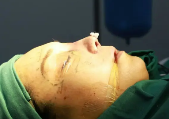 鼻小柱延长手术,又一个为精致女人而诞生的技术
