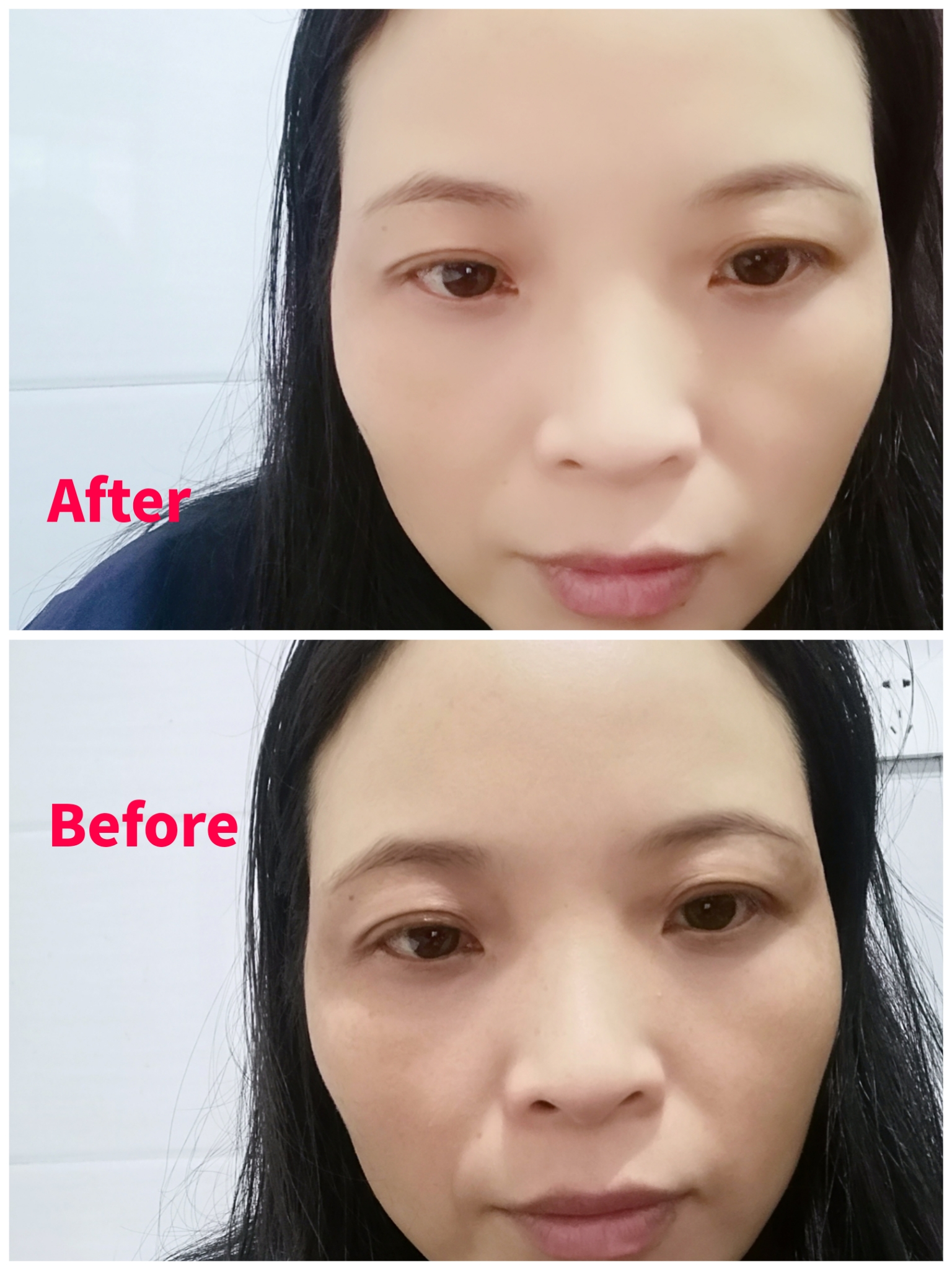 7815菲洛嘉水光针的主要功效是将透明质酸注射在我们的皮肤中