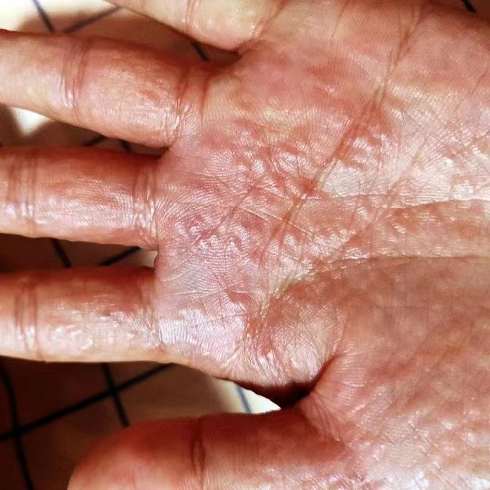 夏天手上密密麻麻长水泡,竟是汗疱疹惹的祸!点进看解决办法!