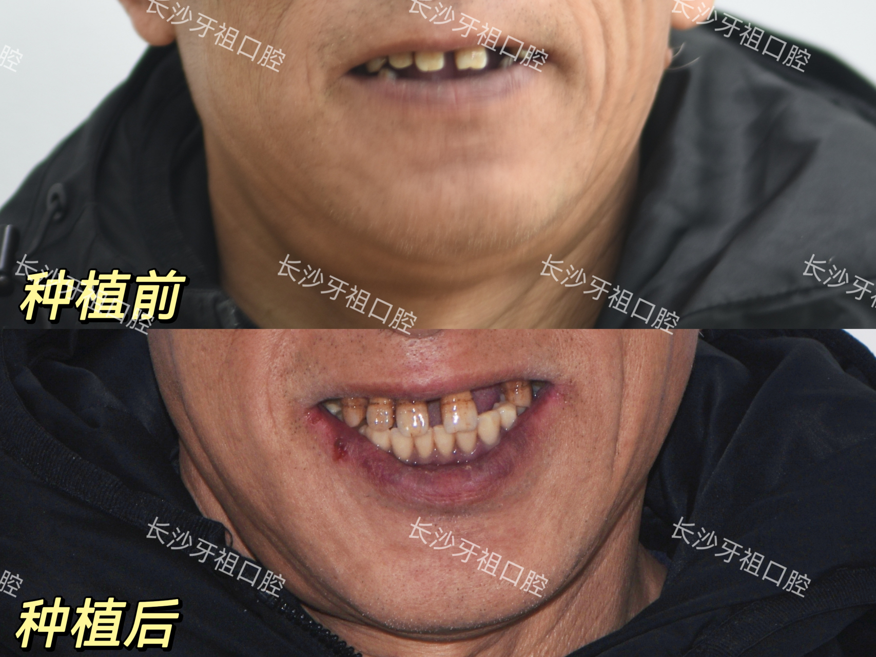 牙齿健康# #种植牙# 半口牙种植案例!