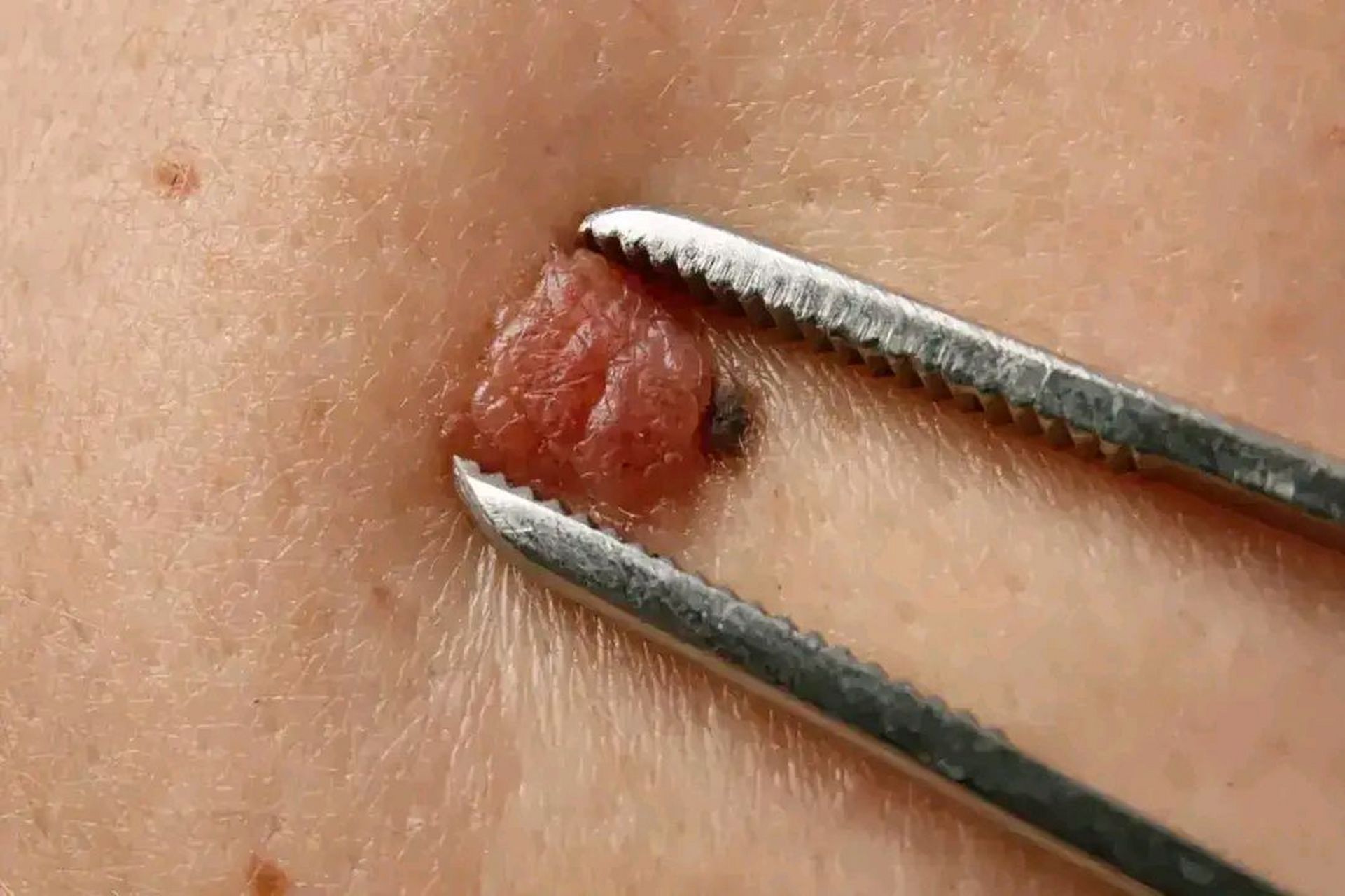 痣会变恶性肿瘤?别怕!医生教你3招自查!