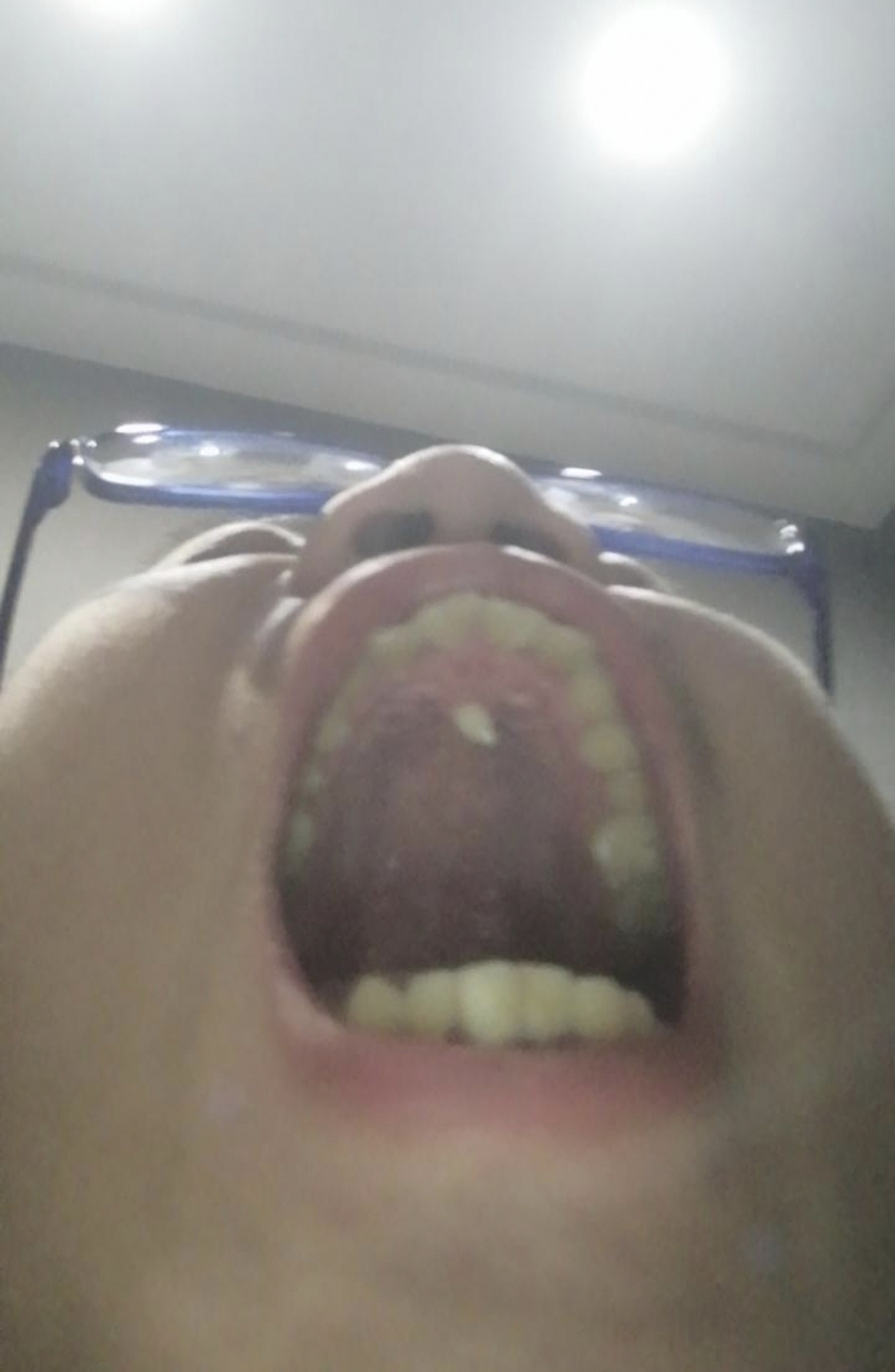 兄弟们,我上膛长了个牙,不疼不痒,也不耽误吃东西,有必要拔掉吗?