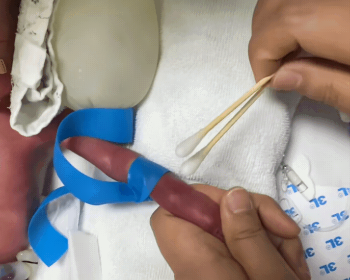 护士给26周0.9公斤早产儿扎针手臂仅有护士手指头粗
