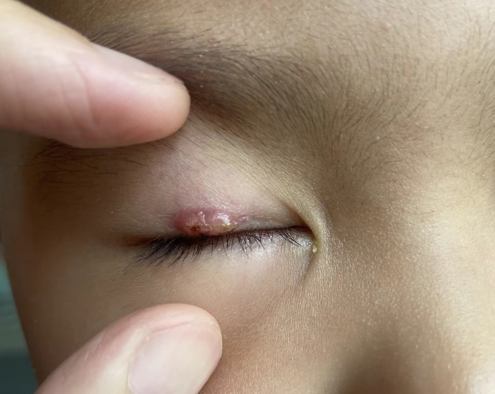 亲们,霰粒肿不手术能自愈吗?愁人啊!