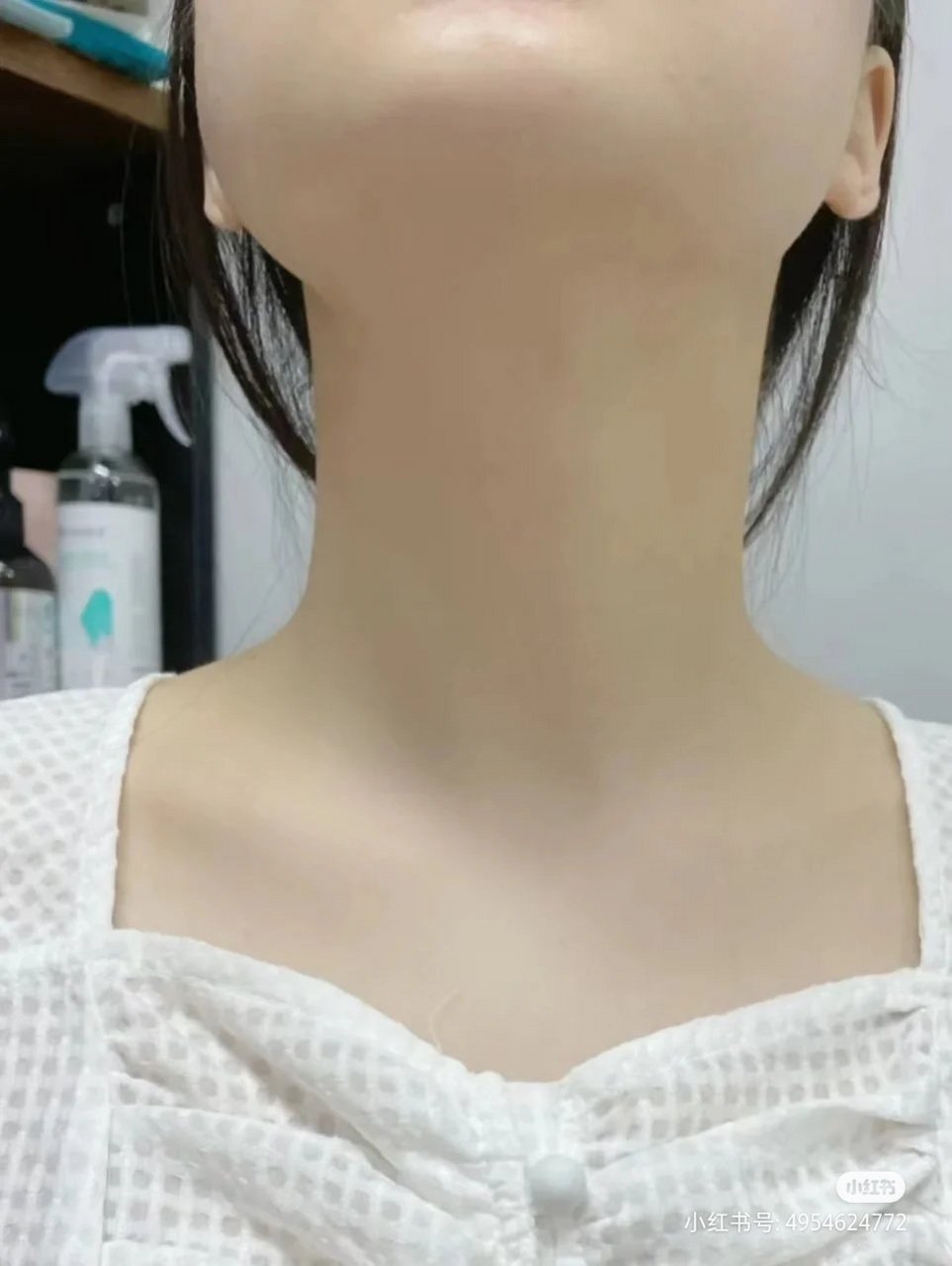 甲亢时候的自己:脖粗,心慌手抖.每次出门都要把脖子遮挡起来.