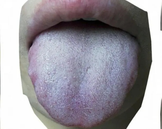 手脚冰凉就是阳虚?桂附地黄丸没用?医生分享肢冷舌象,药方总结