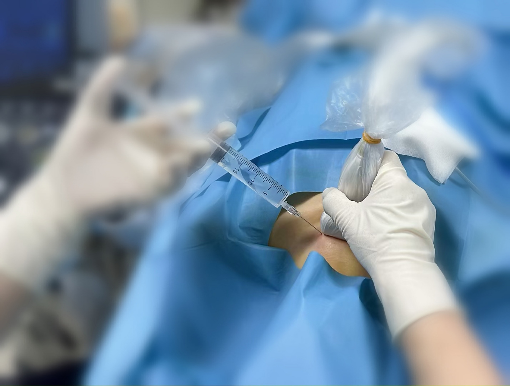 甲状腺结节消融:小针眼,针微创