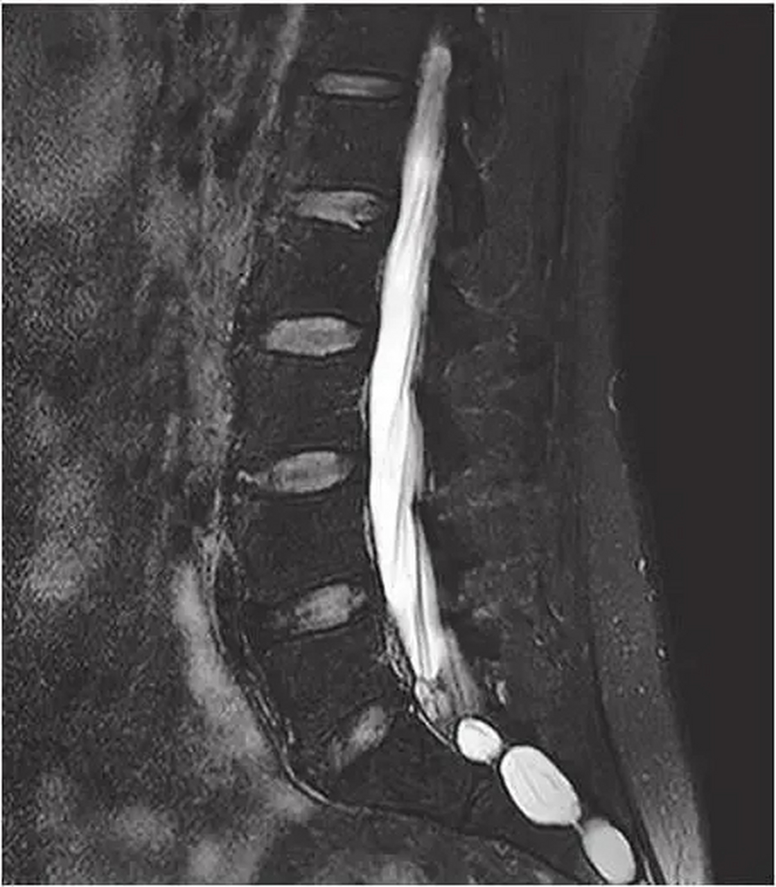 骶管囊肿图片 磁共振图片