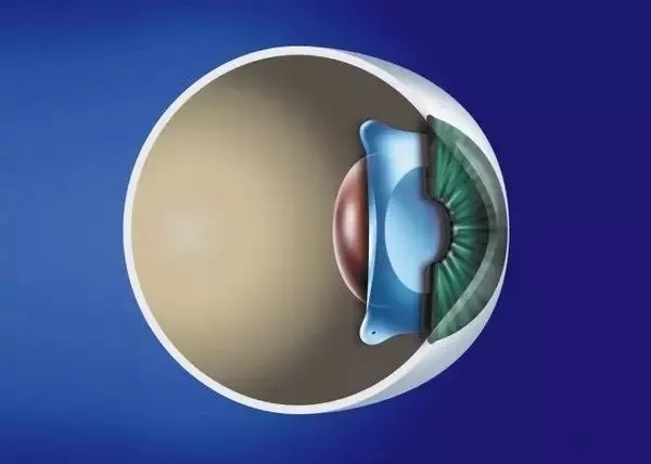 角膜薄,眼睛干,可以做近视手术吗?