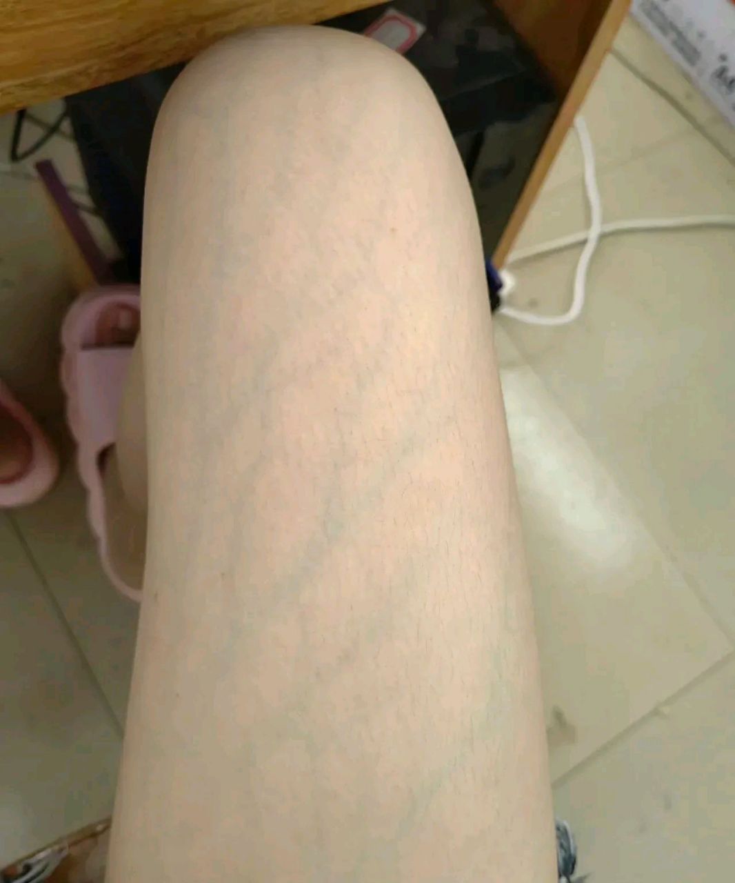 兄弟们,老婆这腿是遍布青筋,要做手术么?