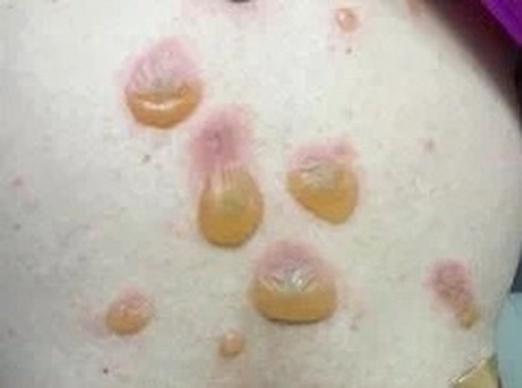 治疗总没效果,一张方子解决你的天疱疮 天疱疮是一种罕见严重的自身