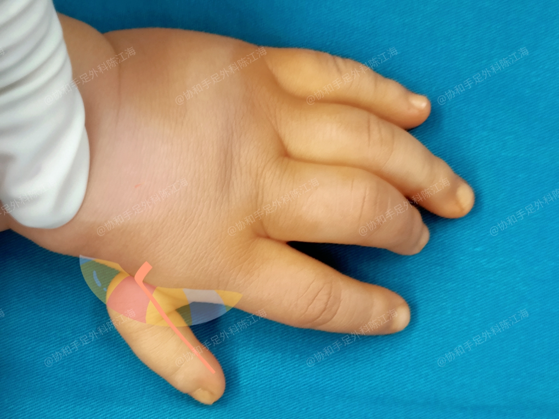 手术治疗前 宝宝一出生,左手拇指和正常的不太一样,整个耷拉在手上
