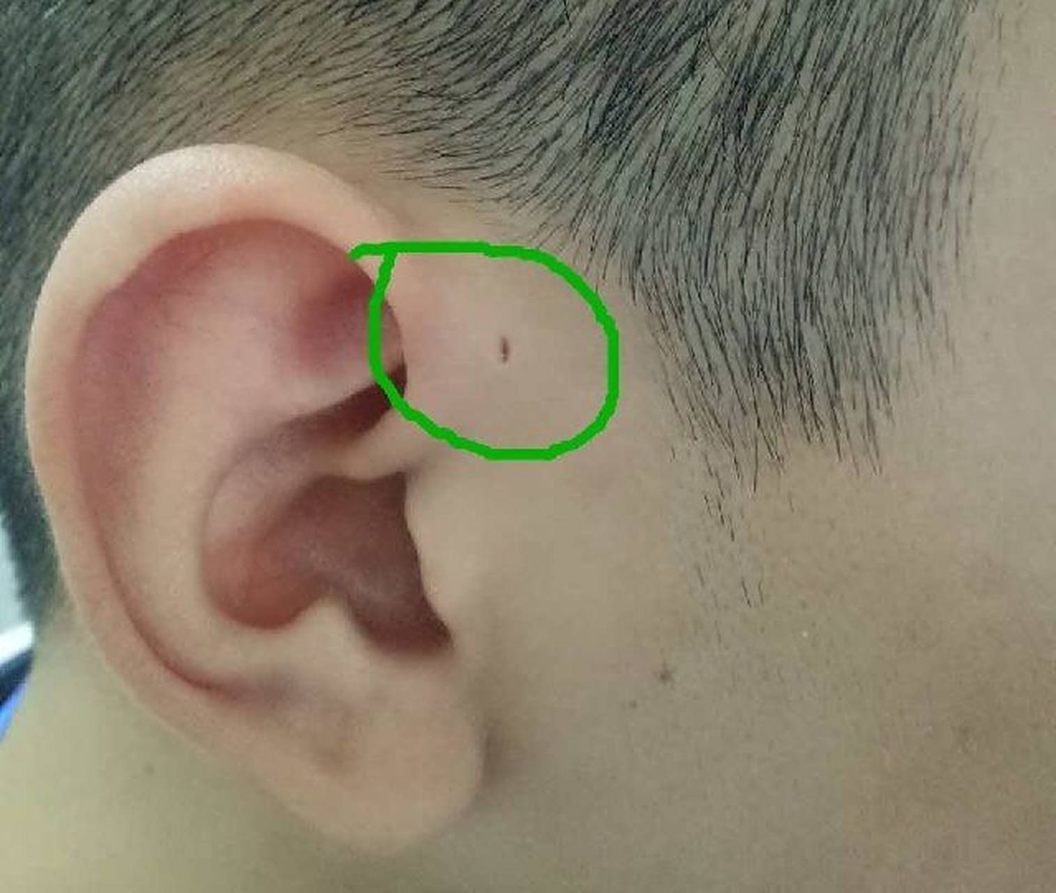 先天性耳前瘘管能证明人由鱼进化来的吗?你有吗?