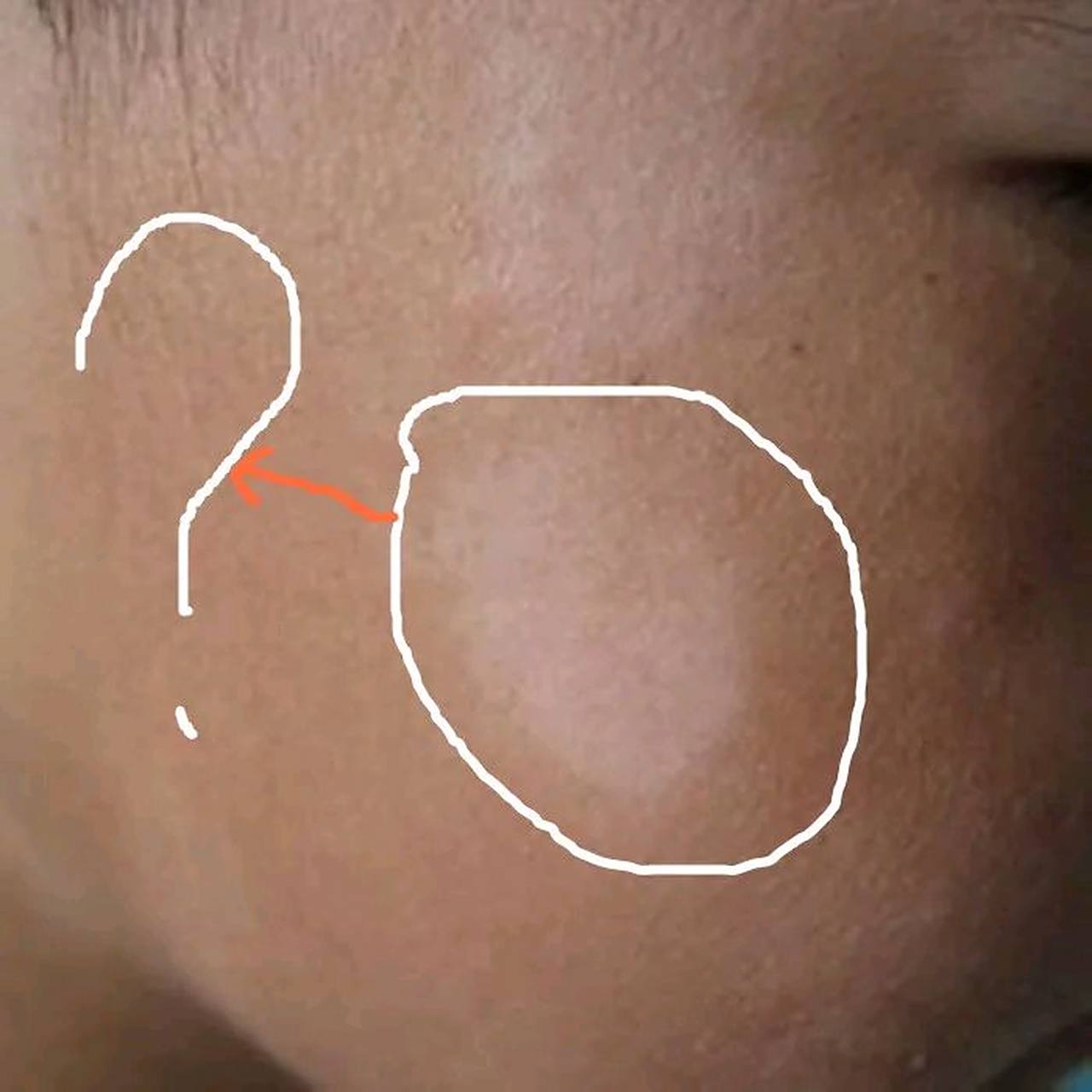 孩子脸上有一块一块的白的,一般是孩子有些缺锌的现象,要给孩子补充含