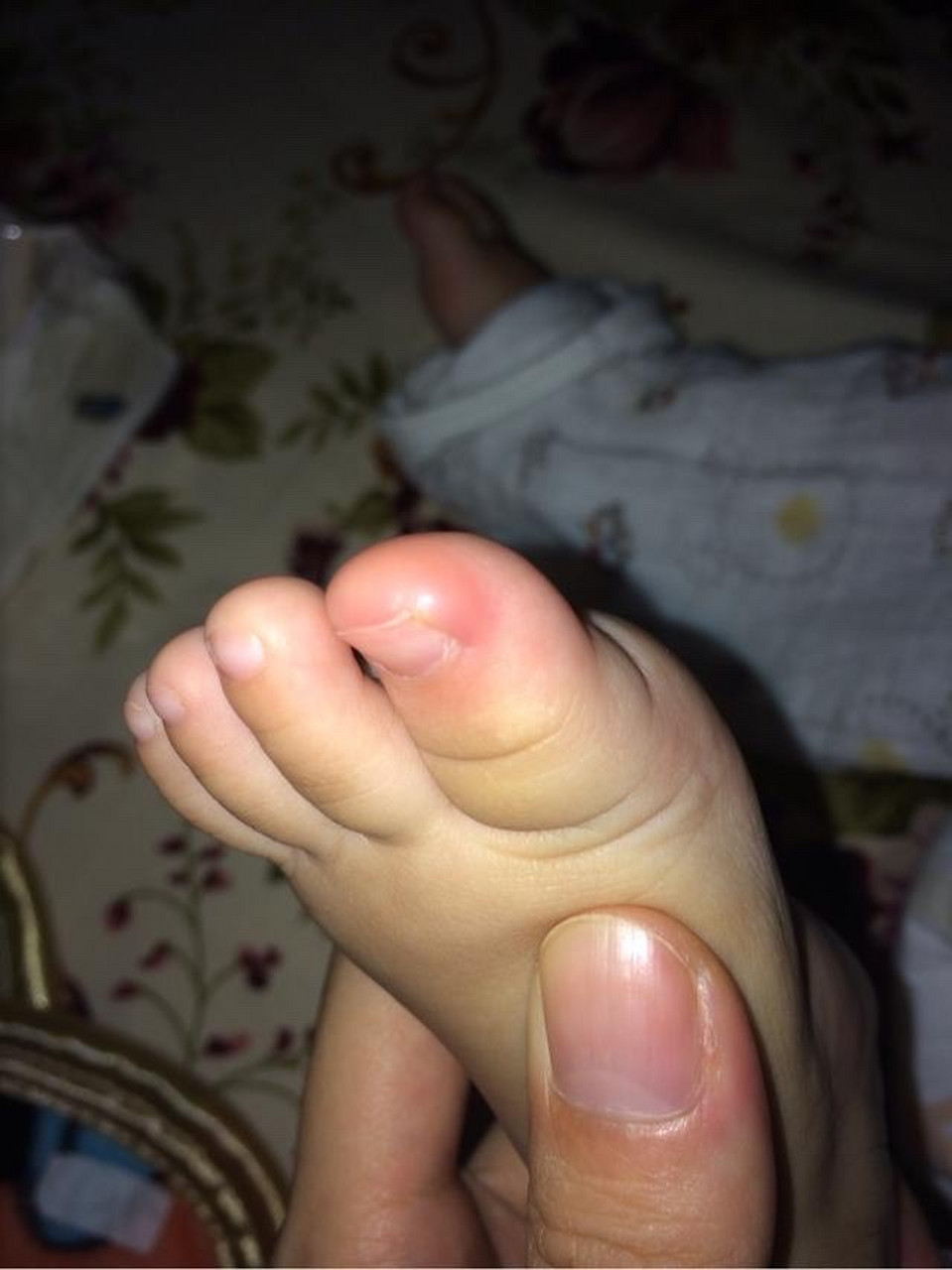 宝宝不让碰大脚趾,边上有点红有点亮,是不是甲沟炎了?