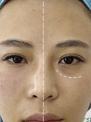 泪沟,又称泪沟纹,是指从眼角往下延伸的一条纹路,让人看起来疲惫不