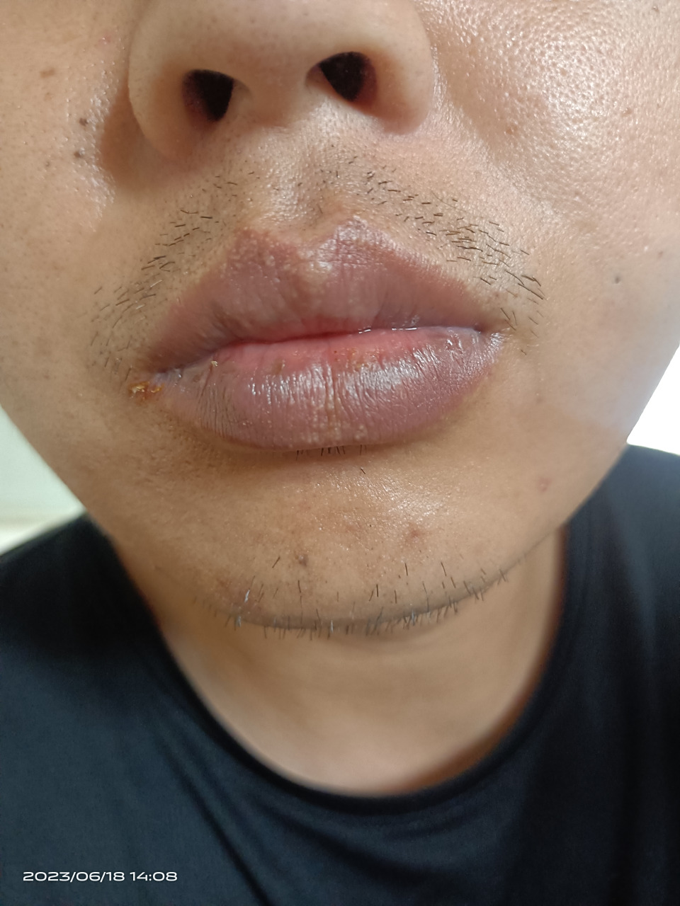 长期吸烟会导致嘴唇发黑发紫,下图是我戒烟图片,戒烟以后嘴唇的颜色