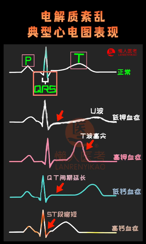 电解质紊乱时有哪些心电图表现?