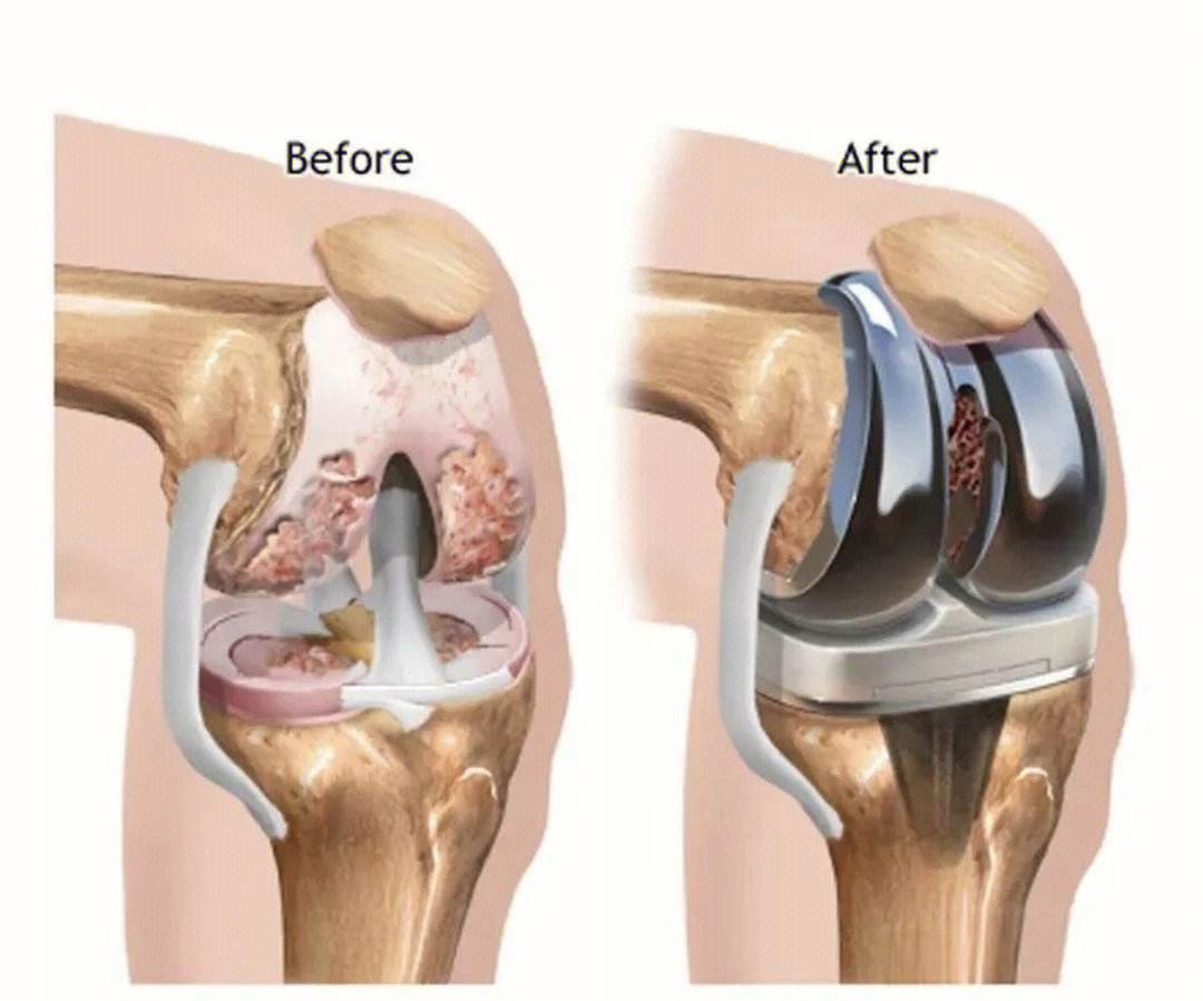 医生,我得了膝关节骨性关节炎,可以保守治疗吗?